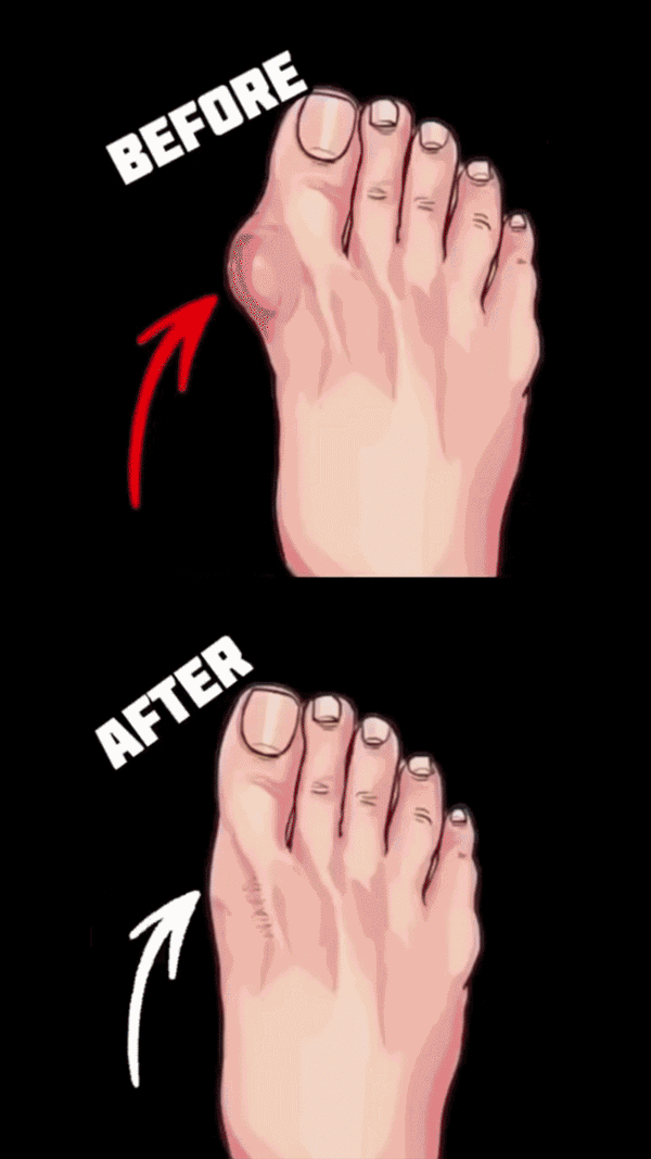 CorectFlex